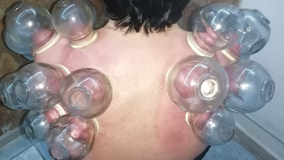 Coppettazione Spalle